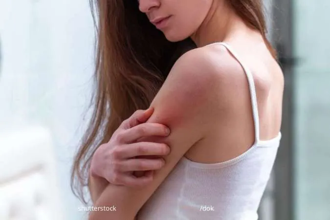 Kenali Penyebab Prurigo dan Cara Mengatasinya