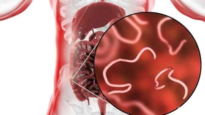 Seorang Balita di Sukabumi Meninggal Tubuhnya Dipenuhi Cacing, Ini Gejala Cacingan
