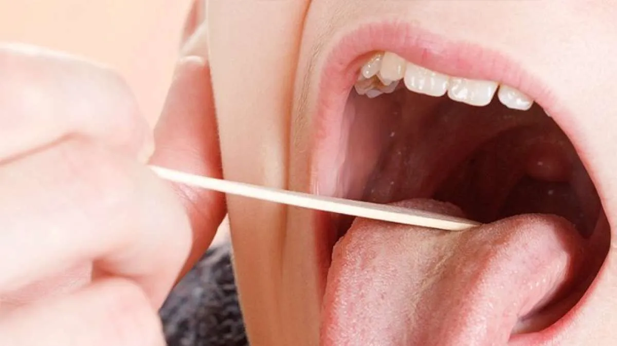 Ini 5 obat amandel alami yang bisa Anda coba di rumah