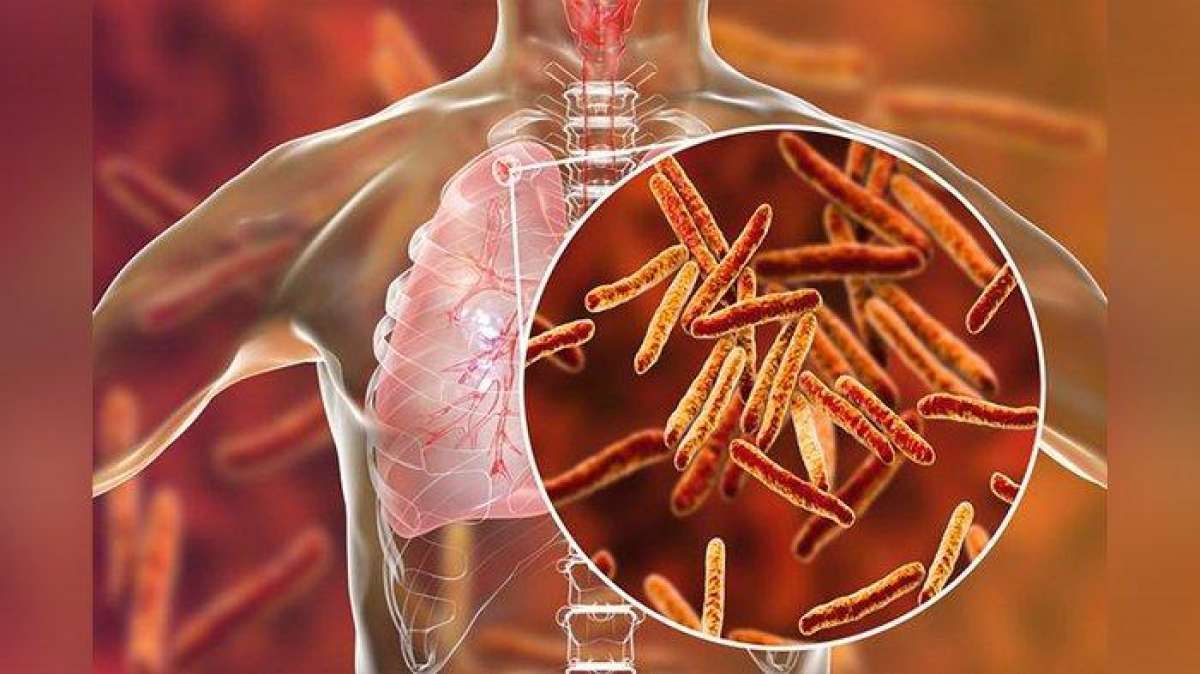 Efek Pandemi, Dana TBC Melonjak Tinggi