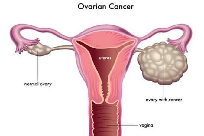 Berikut Cara Mencegah Kanker Ovarium 