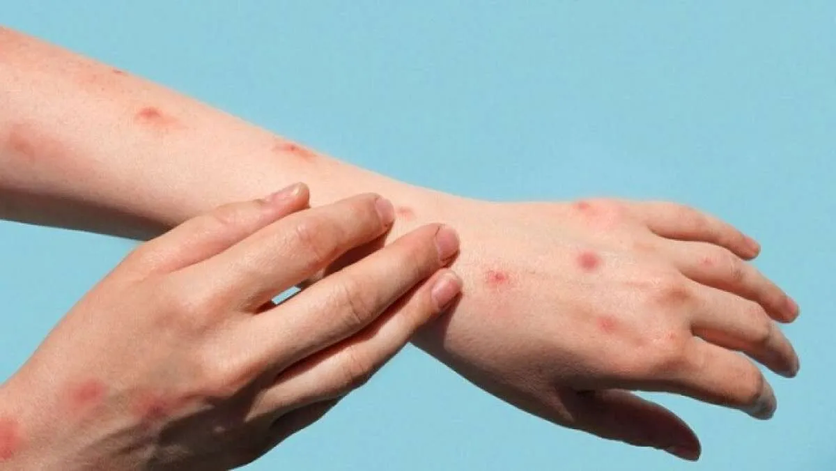 Apa Saja Gejala Mpox atau Cacar Monyet? Intip Selengkapnya di Sini