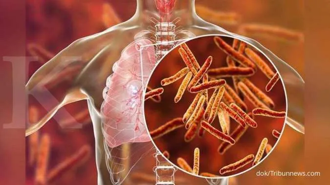 TBC Menjadi Salah Satu Penyakit Berbahaya, Kenali Gejala TBC yang Perlu Diwaspadai