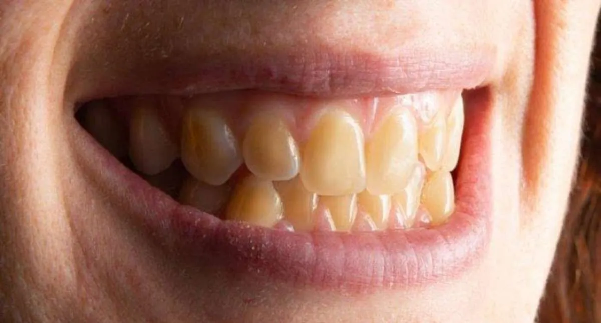 Penyebab Gigi Kuning dan Cara Mengatasinya 