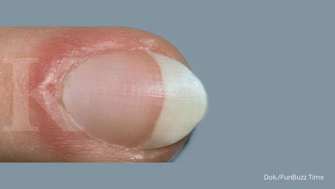Lipatan kuku bengkak