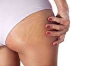 Punya Stretch Mark? Ini 4 Cara Mencegah Stretch Mark Semakin Parah