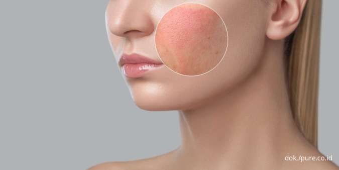 4 Penyebab Wajah Memerah Setelah Pakai Skincare
