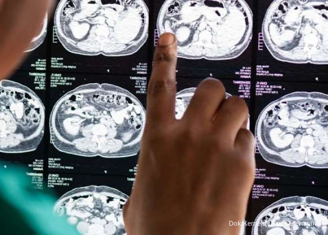 Deteksi Dini Stroke, RS PON Hadirkan Layanan Unggulan Brain Check Up