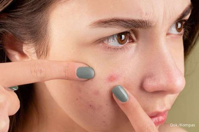 5 Kandungan Skincare untuk Mengatasi Jerawat pada Kulit Remaja yang Aman dan Efektif