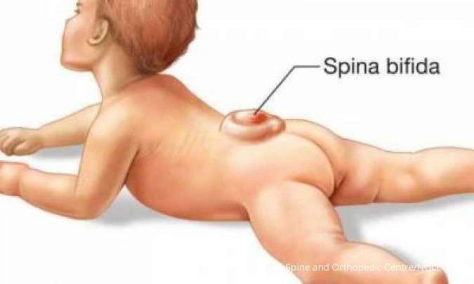 Apa Itu Spina Bifida pada Bayi? Berikut Penjelasan Lengkapnya Moms