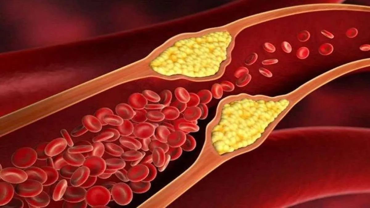 7 Bahaya Kadar Kolesterol Jahat yang Tinggi bagi Kesehatan