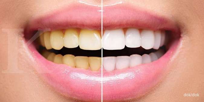 Cara Memutihkan Gigi yang Kuning dengan Bahan-Bahan Simpel, Cek Apa Saja