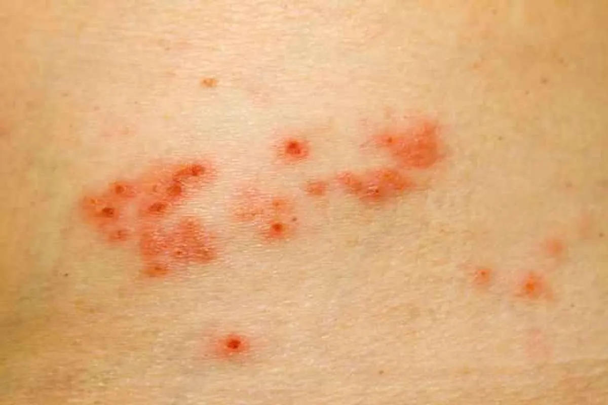 Berasal dari bahan-bahan alami, berikut 6 obat herpes yang bisa Anda jajal