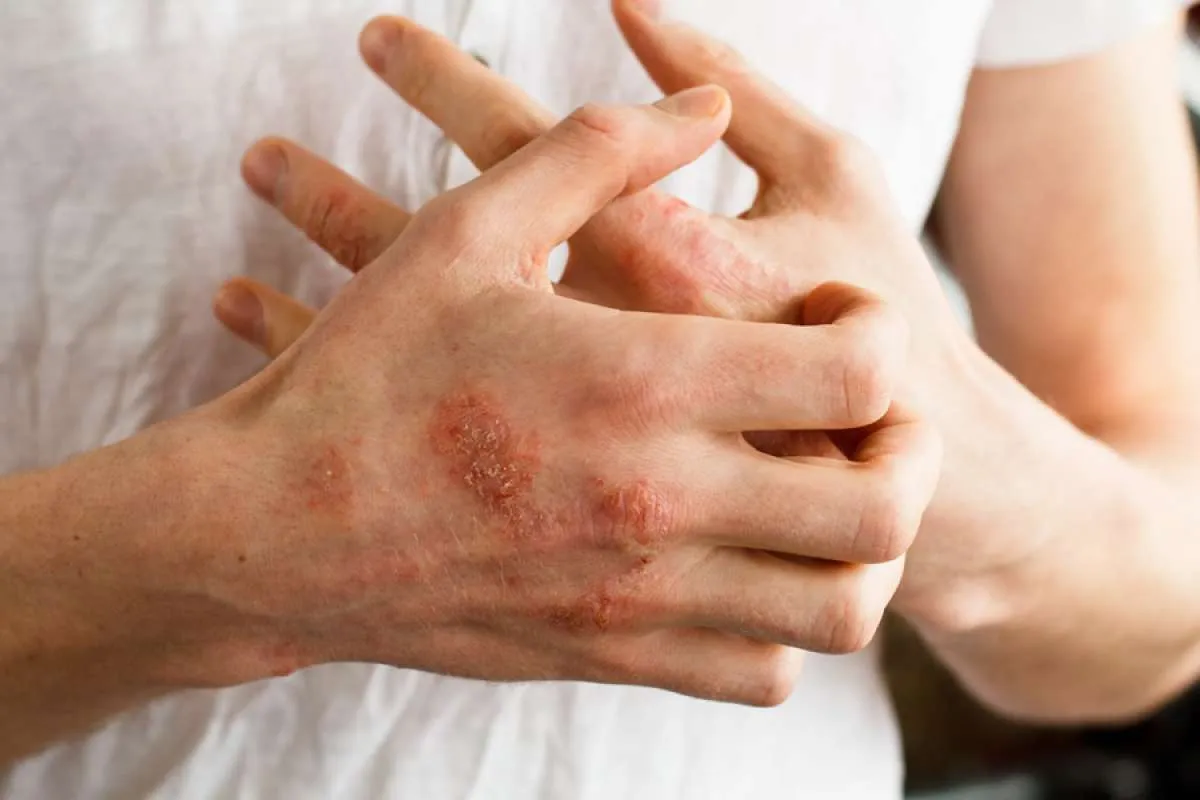 Psoriasis Kambuh? Ini 6 Cara Mengobati Psoriasis di Rumah 