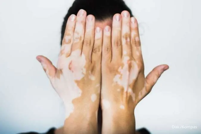 Punya Vitiligo? 6 Cara Ini Bisa Anda Coba untuk Membantu Menyamarkan Vitiligo