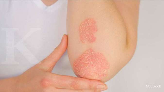 Anda Harus Tahu, Inilah Perbedaan Psoriasis dan Eksim Pada Kulit