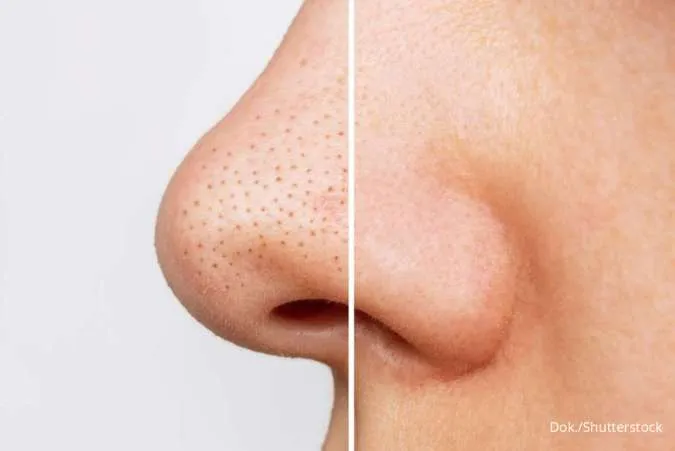 4 Cara Menghilangkan Blackhead dengan Bahan Alami, Mau Coba?