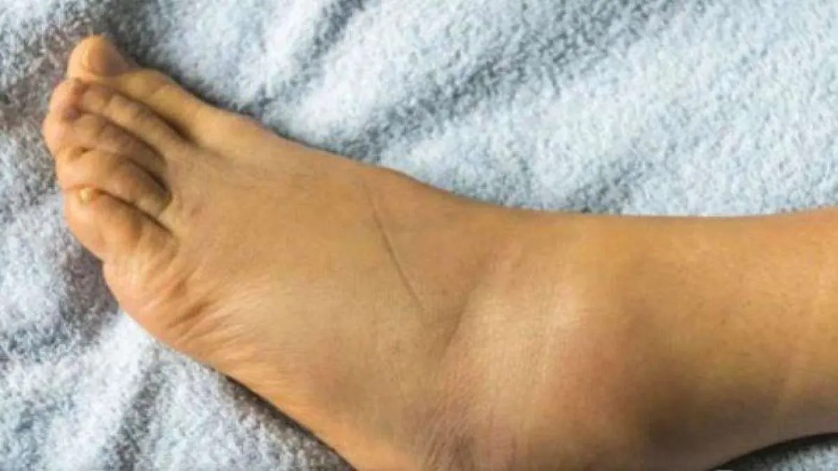 Asam Urat Tak Larut dalam Darah Picu Radang Sendi, Ini 9 Tanaman Herbal Atasi Gout