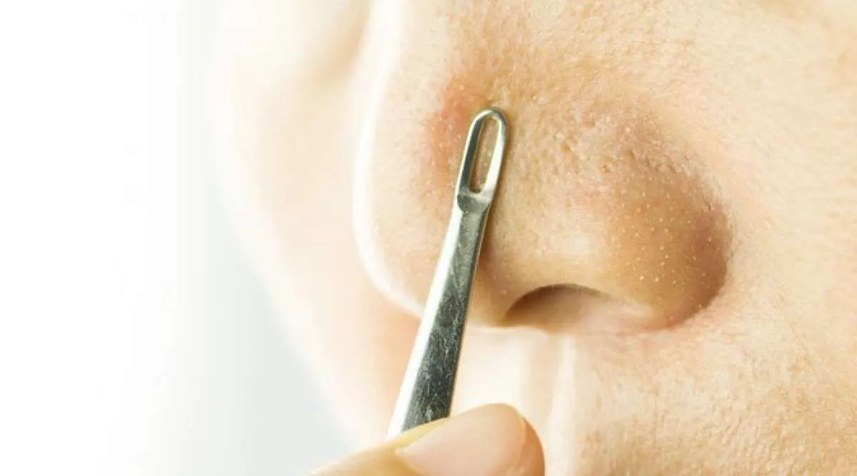 Bisa Pakai Retinol, Ini 4 Cara Menghilangkan Komedo Putih yang Membandel