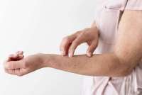 Kenali Gejala Roseola Gabagen pada Bayi & Bedanya dengan DBD