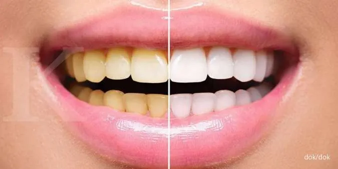 Bisa Dicoba, Inilah 5 Cara Memutihkan Gigi Kuning Secara Alami
