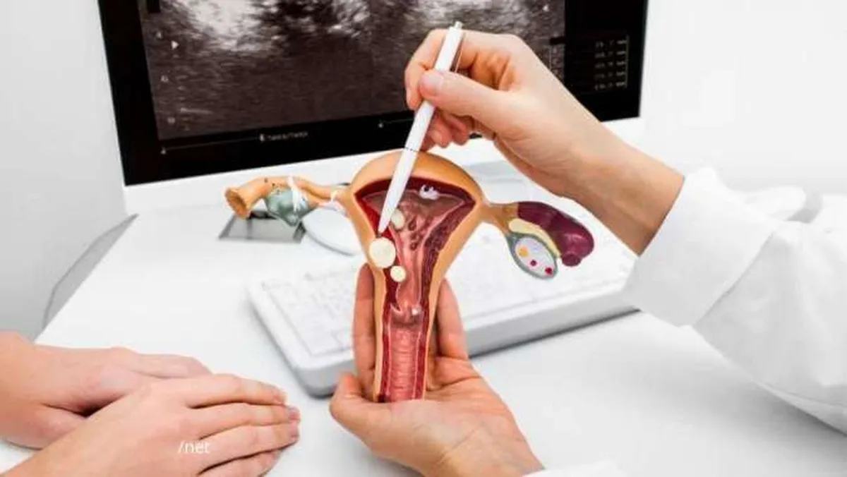 Gejala PCOS yang Perlu Diperhatikan dan Penyebabnya, Perempuan Perlu Tahu