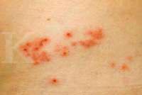 Waspada Penyakit Cacar Api, Bisa Berisiko Terkena Penyakit Berbahaya Ini