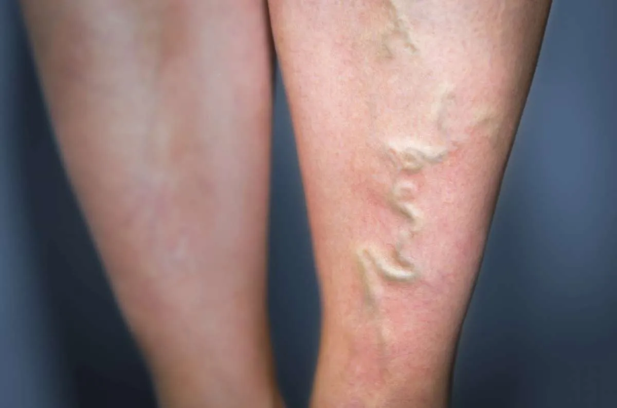 Mengenal Varises dari Gejala hingga Terapi untuk Menyembuhkan Varises