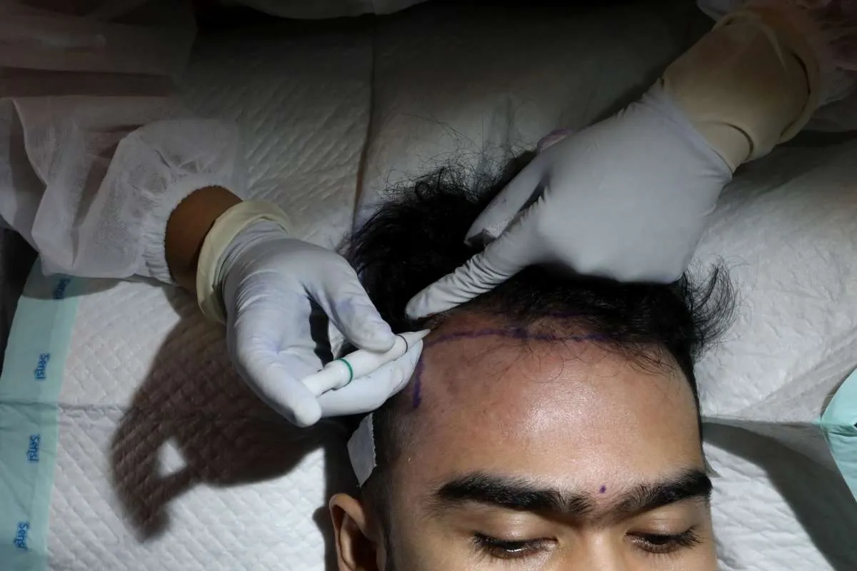 Ini 8 Makanan untuk Mencegah Kebotakan Dini hingga Rambut Rontok