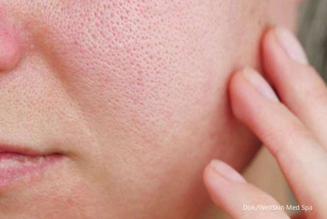 5 Kandungan Skincare yang Ampuh Mengecilkan Pori-Pori Wajah