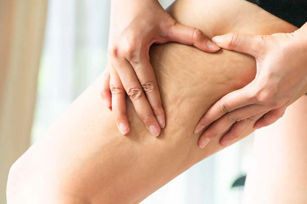 4 Tips Hilangkan Strecth Mark, Dari Perawatan Klinik Hingga Rumahan 