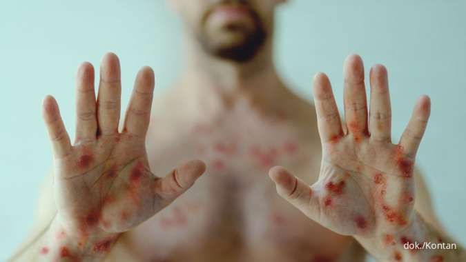Apa itu Mpox atau Cacar Monyet? Penyakit Menular yang Ditandai dengan Ruam Kulit