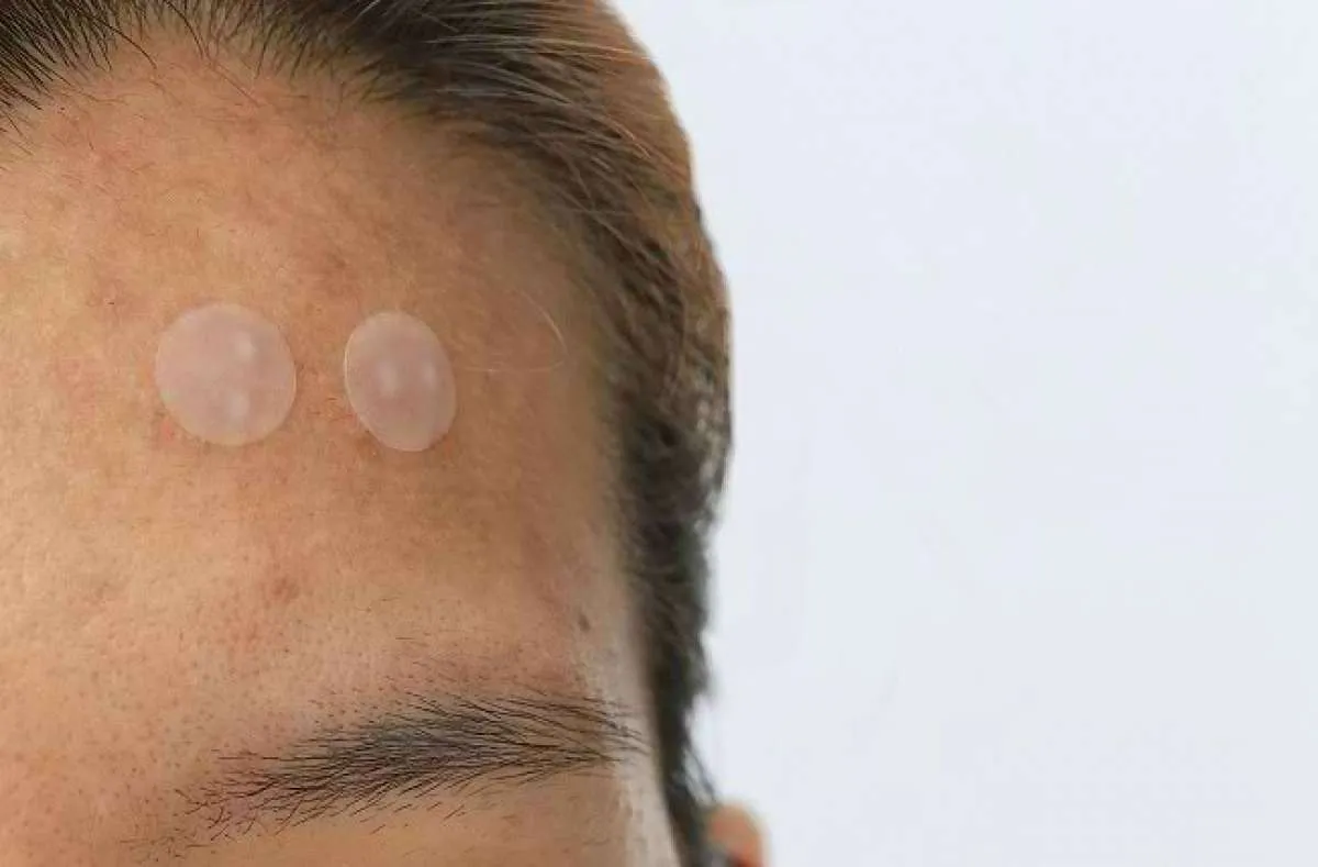 Microneedle Acne Patch Bikin Jerawat Lebih Mudah Kempis? Ini Penjelasannya