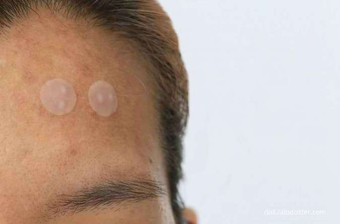 Microneedle Acne Patch Bikin Jerawat Lebih Mudah Kempis? Ini Penjelasannya