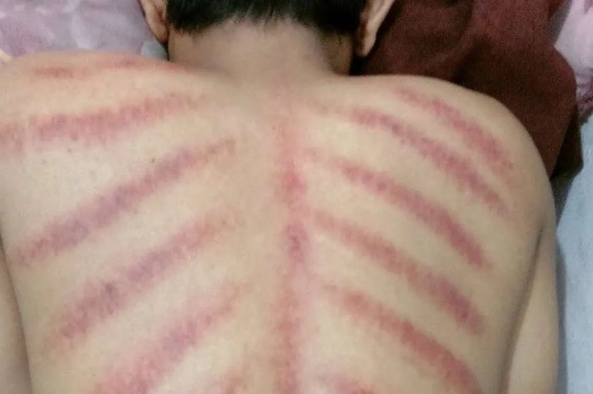 6 Manfaat Kerokan bagi Kesehatan yang Jarang Diketahui