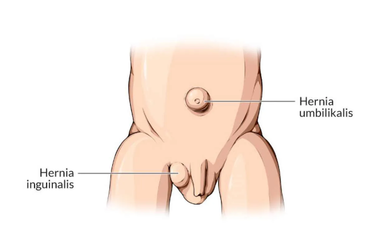 Hernia Pada Bayi: Jenis, Gejala, dan Penyebabnya yang Perlu Diketahui