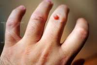 Kenali 6 Pengobatan Mata Ikan beserta Penyebabnya yang Perlu Diwaspadai