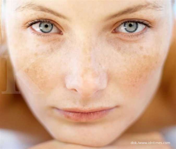 Pahami Cara Mengatasi Sun Spot Pada Wajah di Usia 20an, Cobain Yuk!
