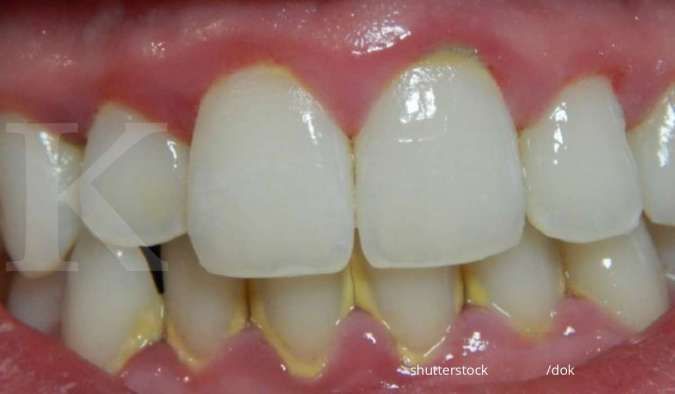 Tak Perlu Bayar, Bagaimana Membersihkan Karang Gigi dengan BPJS Kesehatan? 