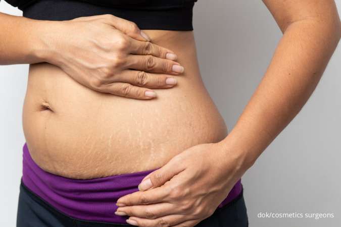 Ibu Hamil Wajib Tahu Cara Cegah Stretch Marks dengan 5 Rahasia Ini