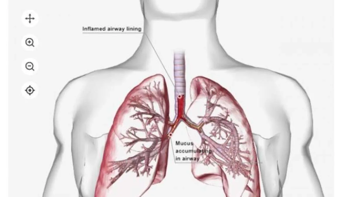 Dokter Menyebut Kasus Pneumonia Anak Melonjak 10% di RSAB Harapan Kita