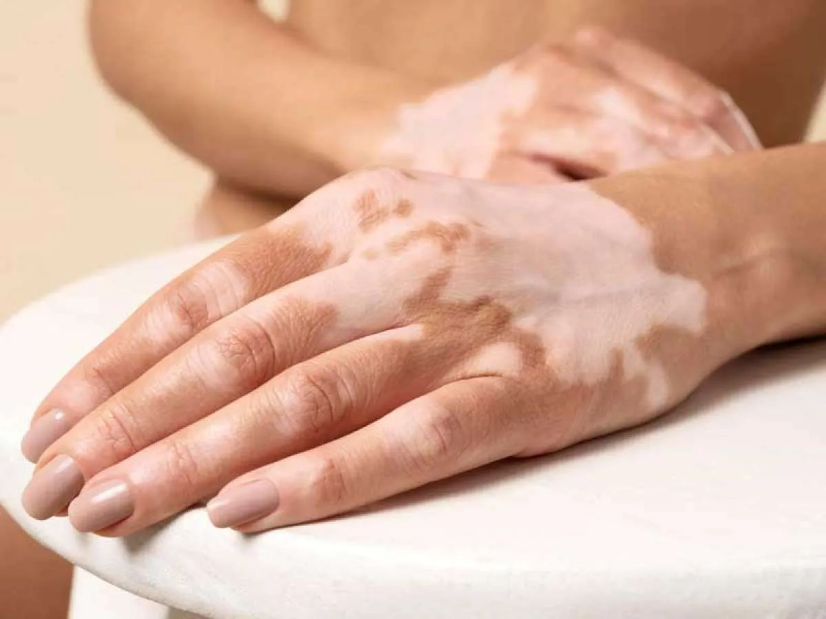 Apakah Vitiligo Berbahaya? Ketahui 4 Fakta Tentang Vitiligo Berikut Ini