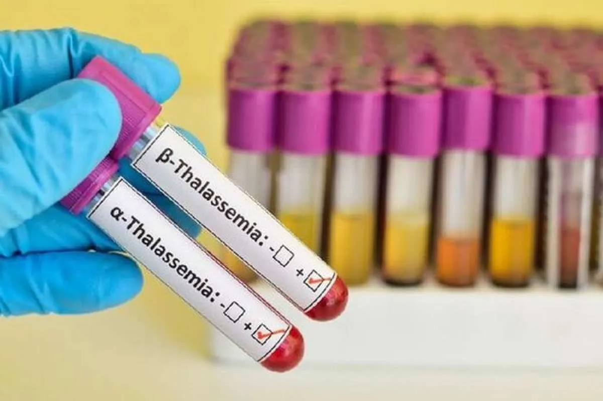 Apa Itu Thalassemia? Kenali Tanda dan Cara Mencegah Kondisi Kesehatan Ini