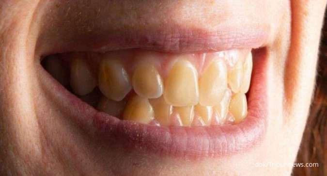 Penyebab Gigi Kuning dan Cara Mengatasinya 