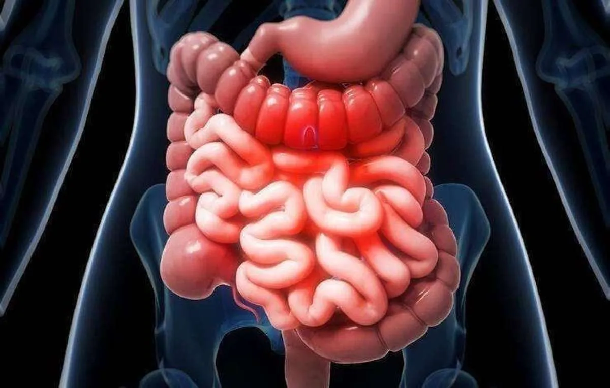 Kenali Penyebab & Gejala Penyumbatan Usus, Segera Temui Dokter