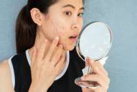 8 Kebiasaan yang Menyebabkan Jerawat Semakin Parah, Stop Sekarang Juga!
