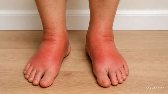 10 Gejala Gagal Ginjal yang Perlu Diwaspadai, Salah Satunya Kaki Bengkak