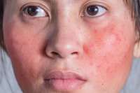 4 Penyebab Skin Barrier Rusak dan Tak Kunjung Sembuh, Hindari Over-Exfoliation
