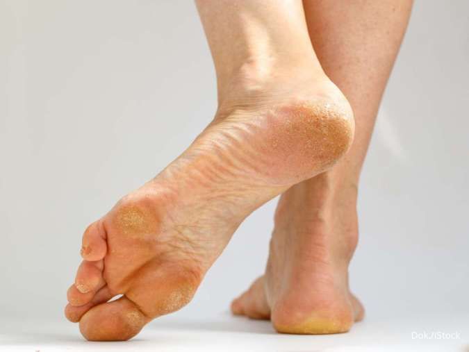 4 Cara Menghilangkan Kapalan di Kaki yang Efektif, Bisa Pakai Garam!