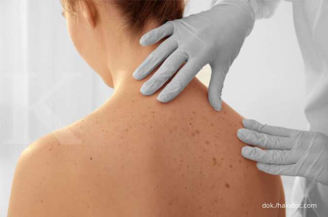 Pahami 3 Cara Menghilangkan Tekstur Kulit Akibat Keratosis Pilaris